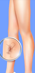 Varicose